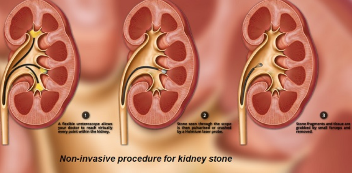 Retrograde Intrarenal Surgery (RIRS)